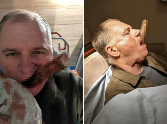 An image collage containing 2 images, Image 1 shows Nikolai, 47, with a shovel handle impaled in his face while holding a bloody cloth to his mouth, Image 2 shows A man lying down with a shovel handle impaled in his mouth